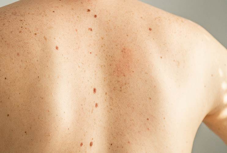spots